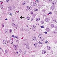 Image result for Leydig-zell-tumor des Hodens. Size: 186 x 185. Source: basicmedicalkey.com