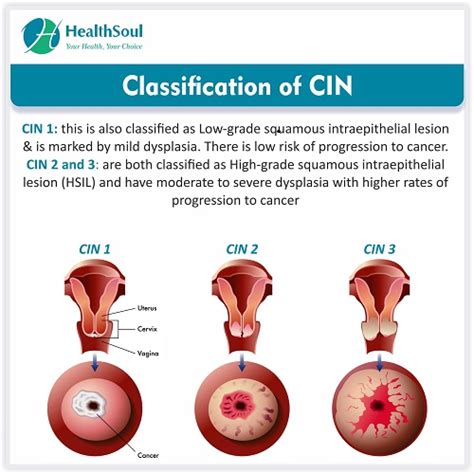 Cervical Intraepithelial Neoplasia Obstetrics Gynecology