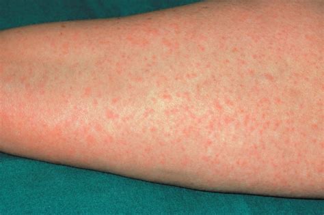 long   drug reaction rash  allergy differences
