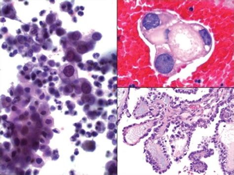 Clear Cell Carcinoma Of The Ovary In A Pelvic Washing Open I