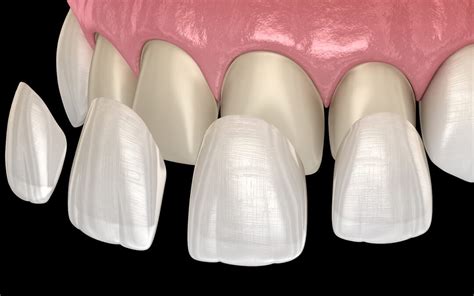dental veneers types  process safar medical