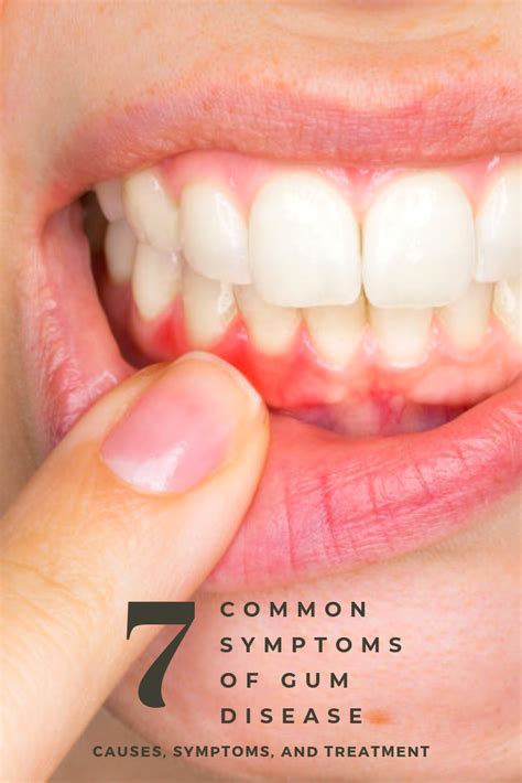 common forms  gum disease  periodontal disease