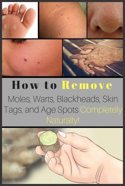 how to remove moles warts blackheads skin tags and age