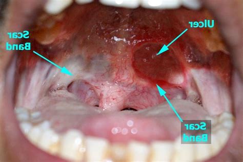 floor lesions mouth photo