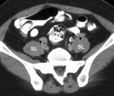 recognition of the ovaries and ovarian origin of pelvic masses with ct