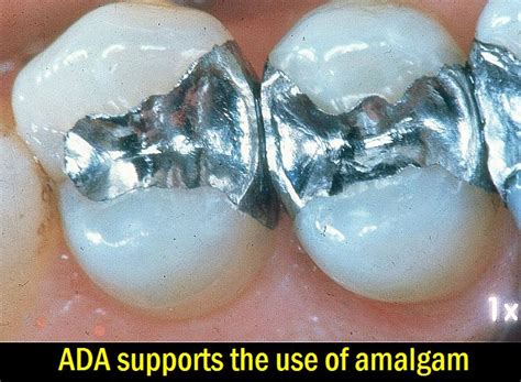 dental news  supports    amalgam odontologia virtual