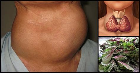 common remedies  natural ways    shrink goiter dr farrah md
