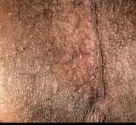 Does This Look Like Herpes Genital Herpes Simplex Forums Patient