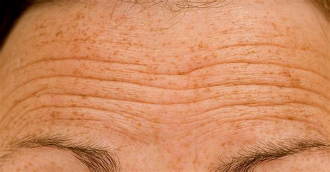 forehead wrinkles  mens  worse    treat  problem