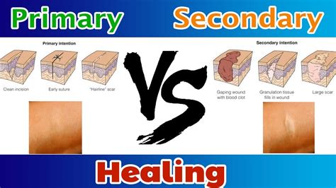 primary healing  secondary healing clear explain youtube