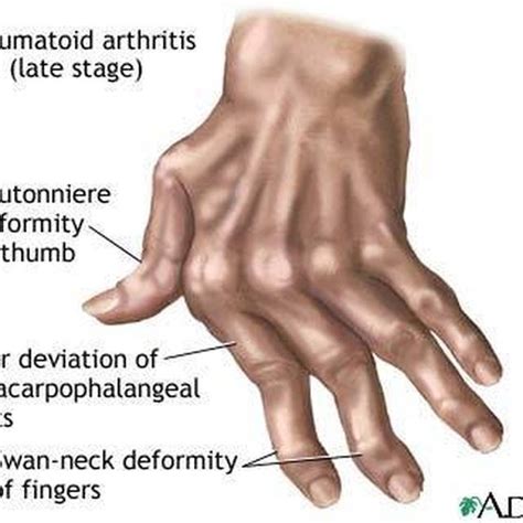 stages  rheumatoid arthritis healthy living