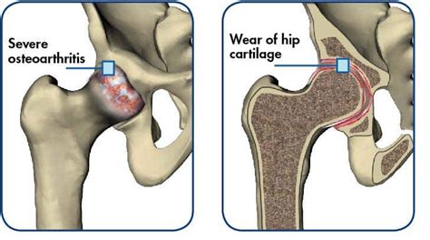 Hip Replacement Surgery Sunshine Coast Orthopaedic Group