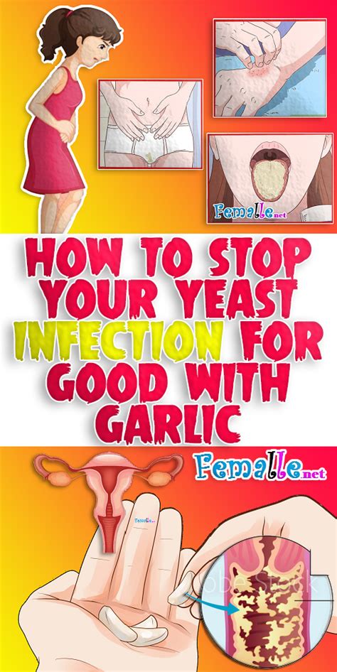 How To Stop Your Yeast Infection For Good With Garlic In 2020 Yeast