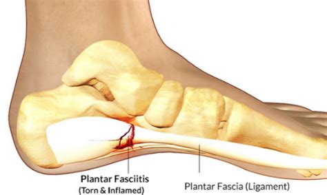 What Does a Heel Spur Look Like? | Remedies for plantar