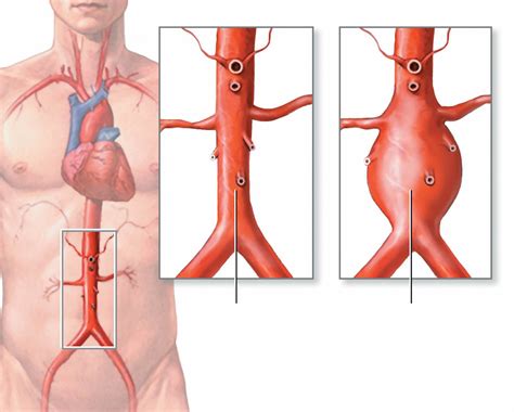 aortic aneurysm abdominal thoracic  symptoms repair