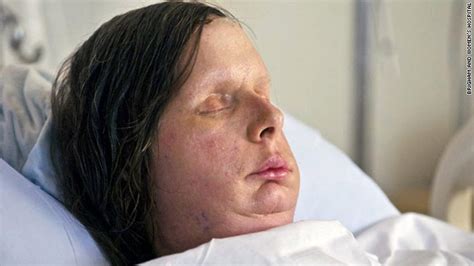 Woman Mauled By Chimp Gets A New Face