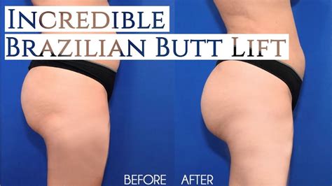 incredible brazilian butt lift bbl   youtube