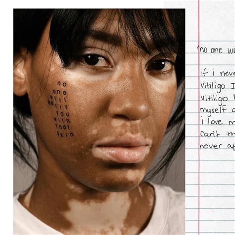 pin by bru vân kiều on fashion with images vitiligo