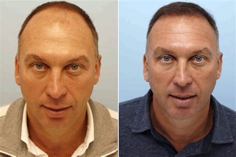 Formerfootballer David Platt Has Hair Transplant But Fans Claim It