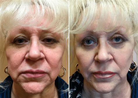 Juvederm Ultra Before And After Photos New Jersey