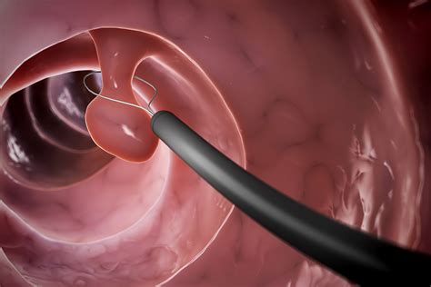 The Importance Of Getting A Colonoscopy Wilmington Health