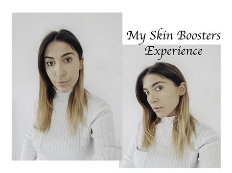 restylane skin boosters experience  london