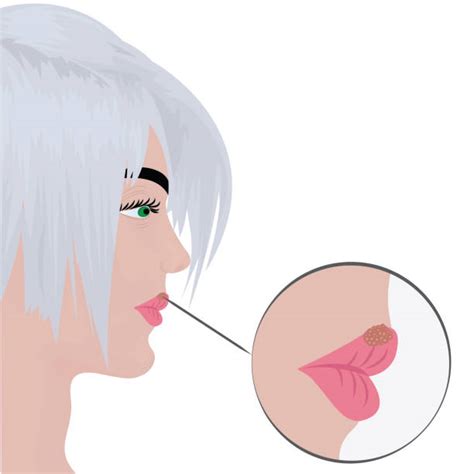 cold sore illustrations royalty free vector graphics and clip art istock