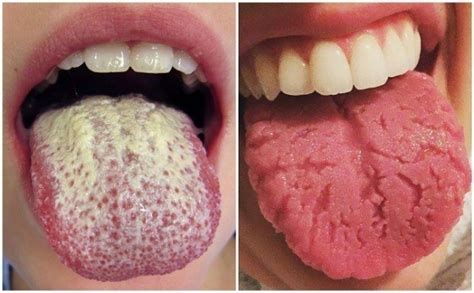 Warning Signs Your Tongue Sends About Your Health How To Instructions