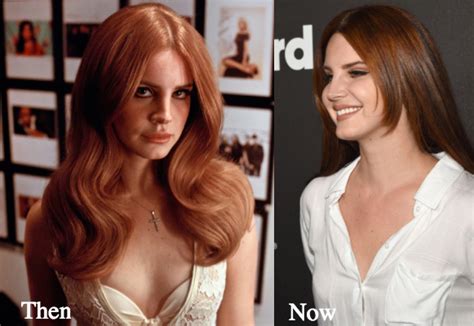 Lana Del Rey Plastic Surgery Before And After Photos