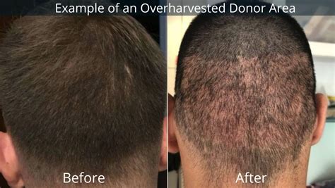 overharvested donor area  hair transplant