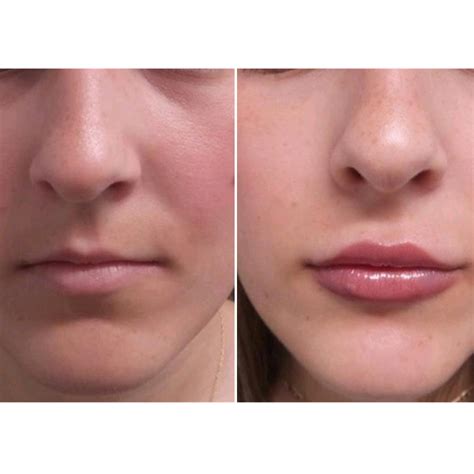 lip enhancement treatment   age thin lips face
