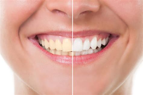 benefits  professional teeth whitening sydney park dental