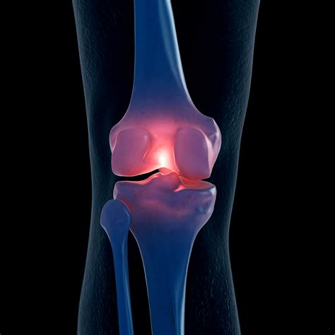 osteoarthritis treatment northeast knee joint institute