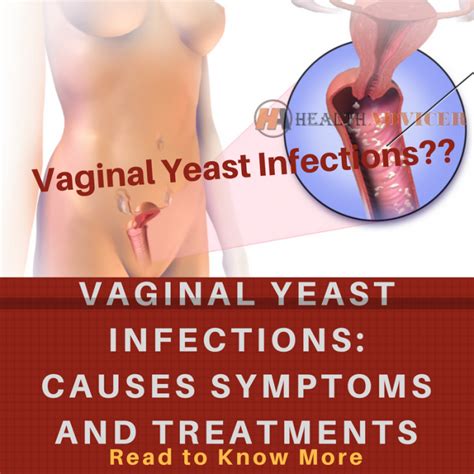 Vaginal Yeast Infections Causes Pictures Symptoms And Treatment
