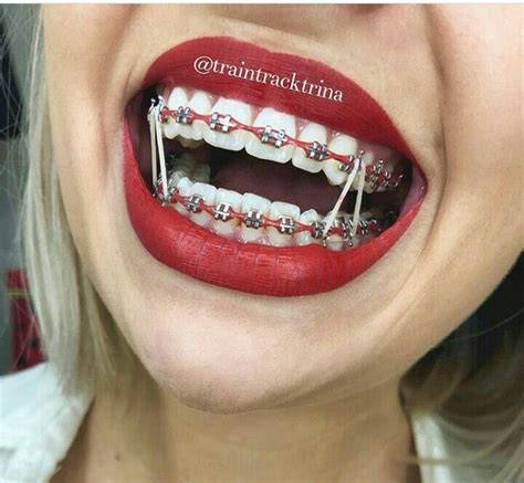 Pin By 𝖢 𝗋 𝗂 𝗌 𝗍 𝖺 𝗅 ♡︎ On Girlw Braces Braces Colors Braces Teeth
