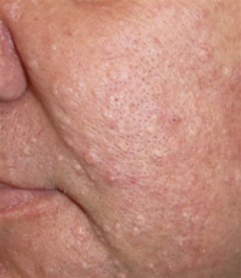 lumps and bumps faciem dermatology clinic