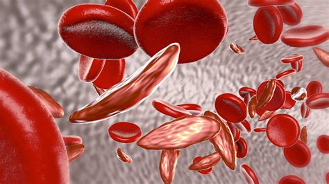 thalassemia symptoms causes and prevention medclique