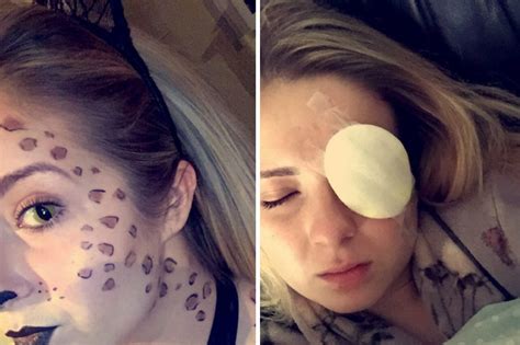 blonde left wearing eyepatch after contact lenses worn for halloween tore out cornea daily star