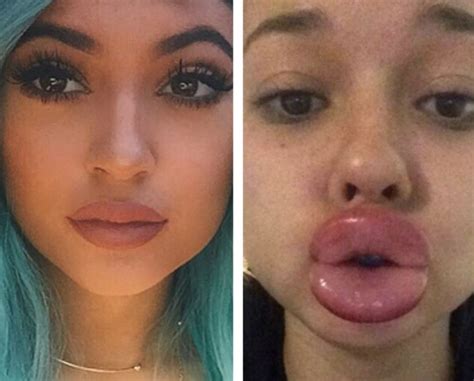 kylie jenner lip challenge gone way wrong