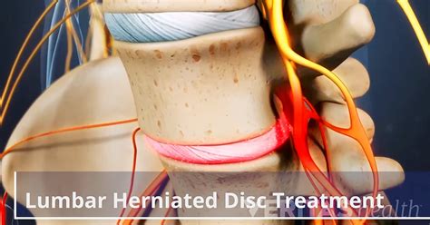 lumbar herniated disc treatment video