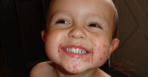 What To Have On Hand For Hand Foot And Mouth Disease