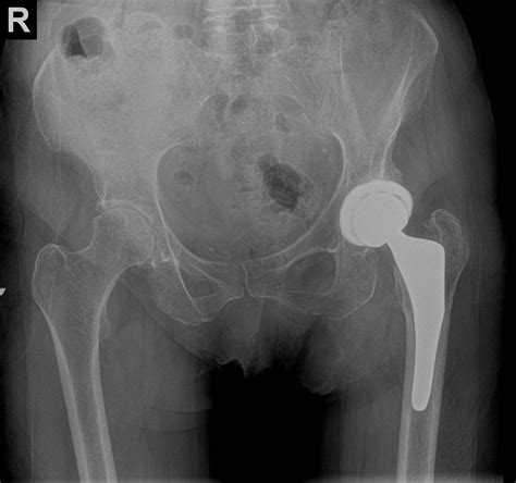 postop total hip anterior replacement
