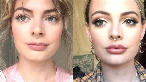 What Not To Do Before And After Lip Fillers