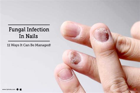 fungal infection  nails  ways    managed  dr niraj