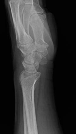 triquetral fracture radiology