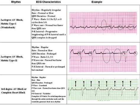 Acls Rhythms Pg 7 Of 7 Nursing Acls Pinterest