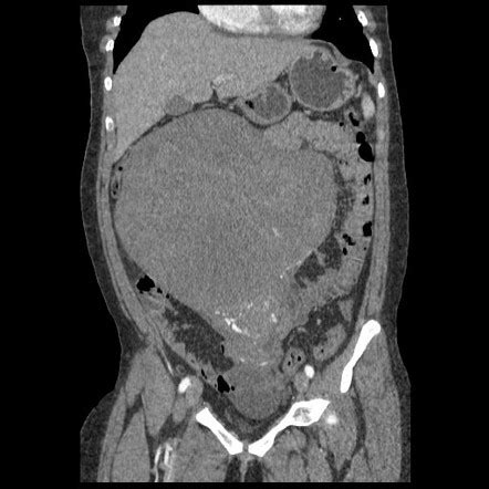 uterine torsion radiology case radiopaediaorg
