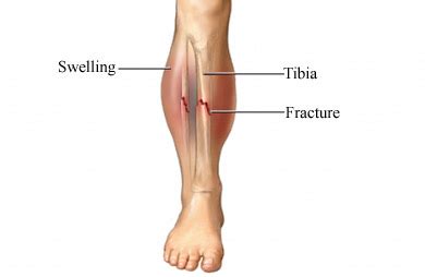 tibia fibula fracture specialist singapore sports orthopaedic surgeon