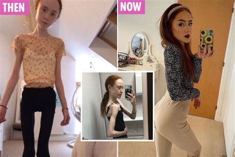 scots girl s hair fell out and weight plunged to just 4st in anorexia