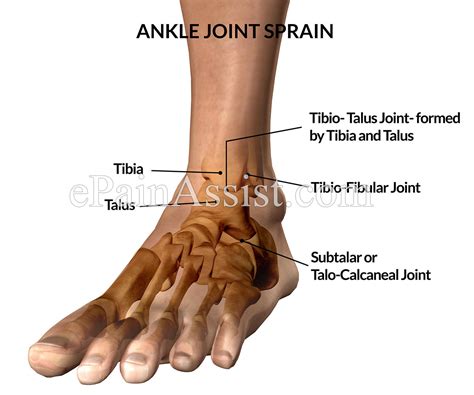 ankle joint spraincausestypessymptomstreatment conservative specific pt